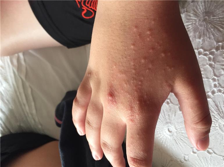 Anyone know if this rash is lupus or not? LUPUS UK