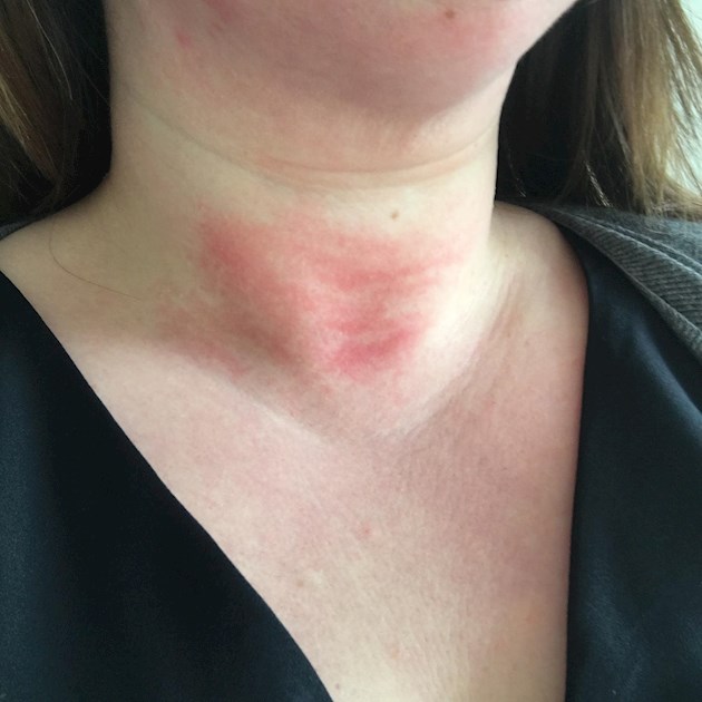 Redness On Neck Does Anyone Get Blotchy Over Thyroid UK