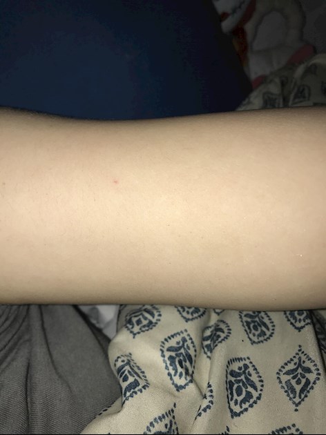 Giftig Mange redde Tiny, red pinpoint dots on my arms.: Hi! I have been... - MY SKIN
