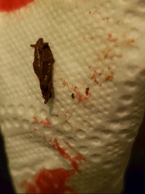 Blood Clot From Rectum I Have Colon Cancer Conn