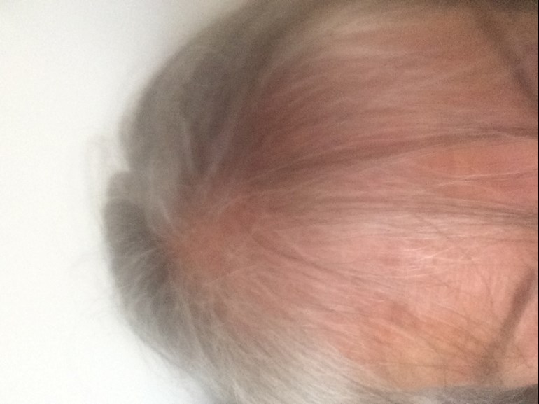 Female pattern baldness. Top of head hair almos... - Thyroid UK