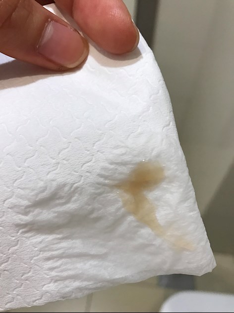 Brownish Mucousy Vaginal Discharge No Aspergillosis And 