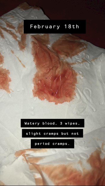 Is This Implantation Bleeding Or Not Im 5 Days Nct