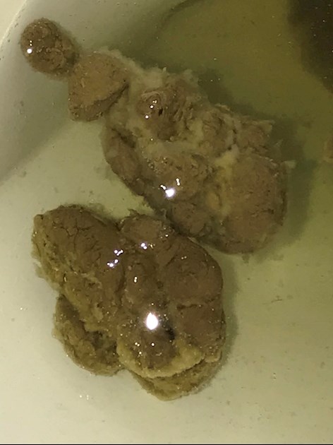 yellow liquid poop before colonoscopy