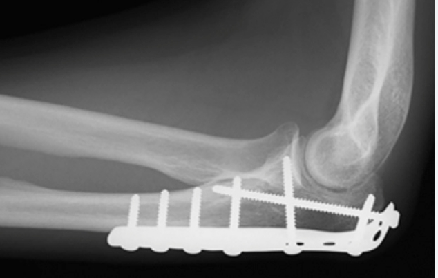 Advice on a flare protocol after elbow break a... | PMRGCAuk