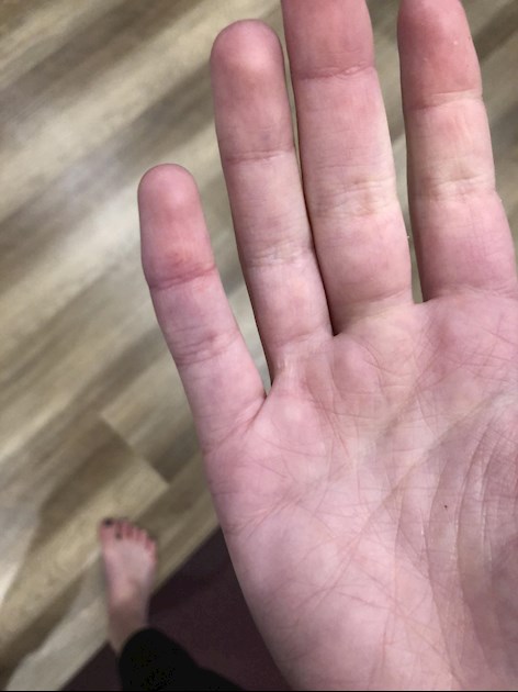 possible-causes-of-white-hard-bumps-on-hands-fingers-with-its