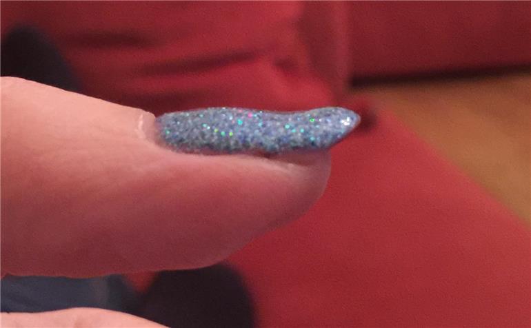 Dips And Ridges In Nails Does Anyone Scleroderma Ray