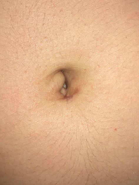 1. What causes lumps in the belly button?