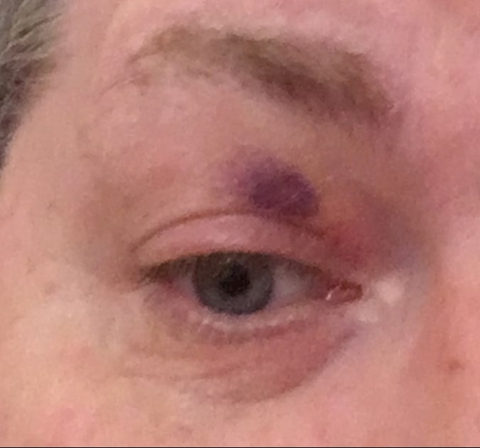 Bruised Eyelid I Woke Up This Morning With Pbc Foundation