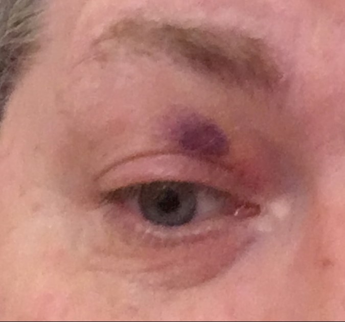 Bruised Eyelid I Woke Up This Morning With PBC Foundation