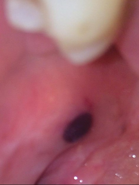 causes of blood blisters in mouth