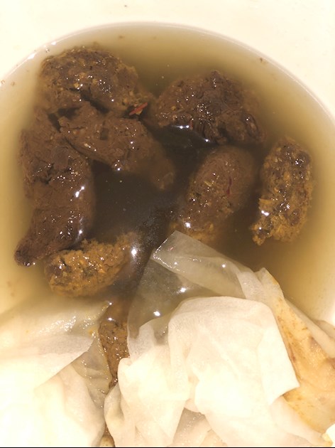 undigested food and blood in stool