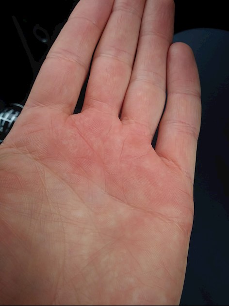 red-blotches-on-hands