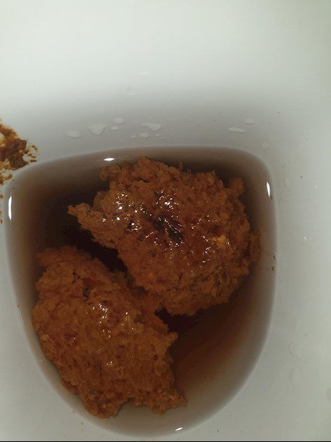 colon-cancer-stool-pictures-blood-in-stool-graphic-picture-warning