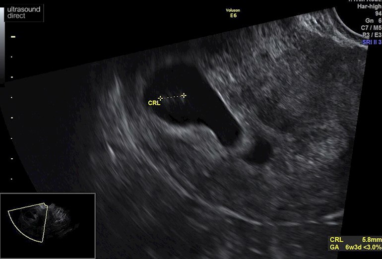 Inconclusive scan: Hi, after 4 failed - Pregnancy and Par