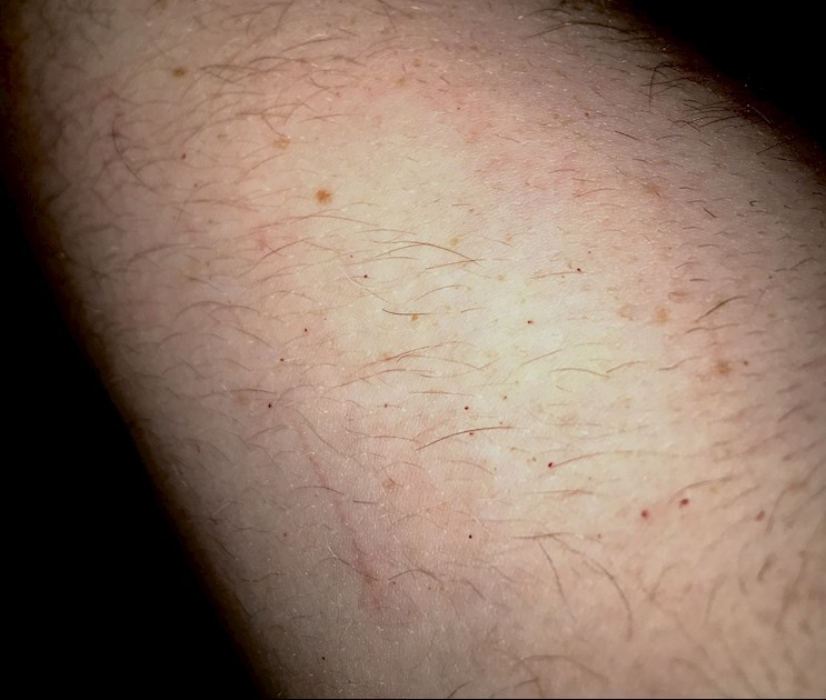 what are red pinpoint spots on skin