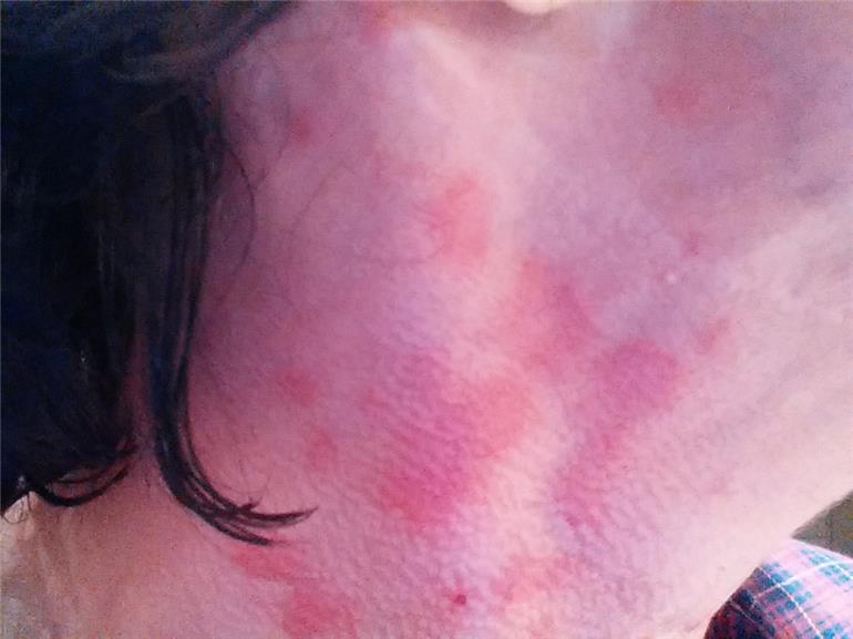 Lupus rash update: My lupus rash is still angry - LUPUS UK