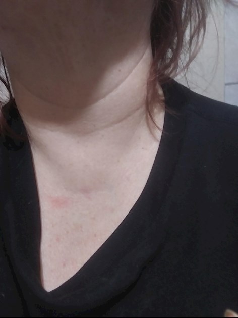 Lump Between My Collarbone Hello My Name Is Thyroid UK