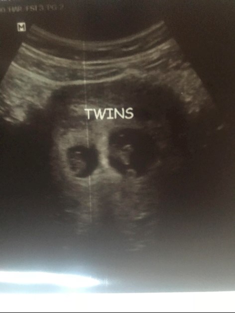 Brown spotting/discharge at 8 weeks (pictures attached)