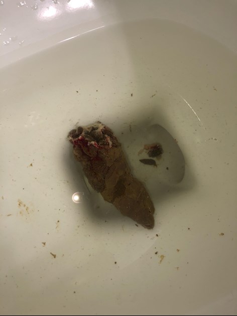 mucus in human feces