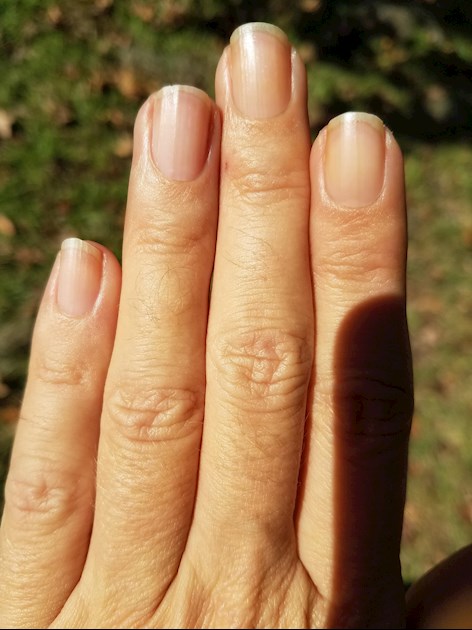 Lung cancer symptoms: Curved nails could be a warning sign of the disease |  Express.co.uk