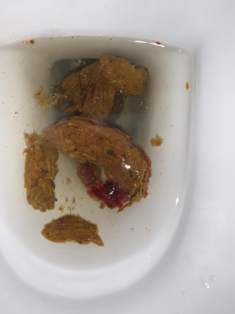 Poop With Blood Can Someone Help Me On Colon Cancer Conn