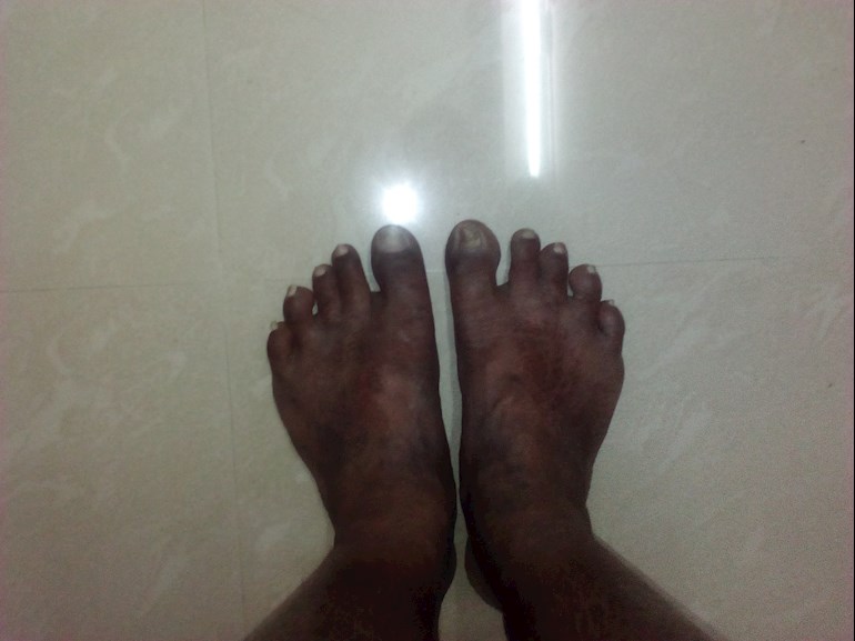 Foot Skin Became Black And Lost Sensitivity Diabetes India