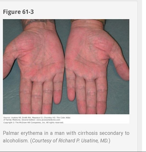 List 102+ Images Palmar Erythema Red Palms Liver Disease Photos Updated