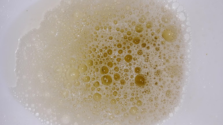 Bubbles In Urine When I Pee I Have To Early Ckd Support