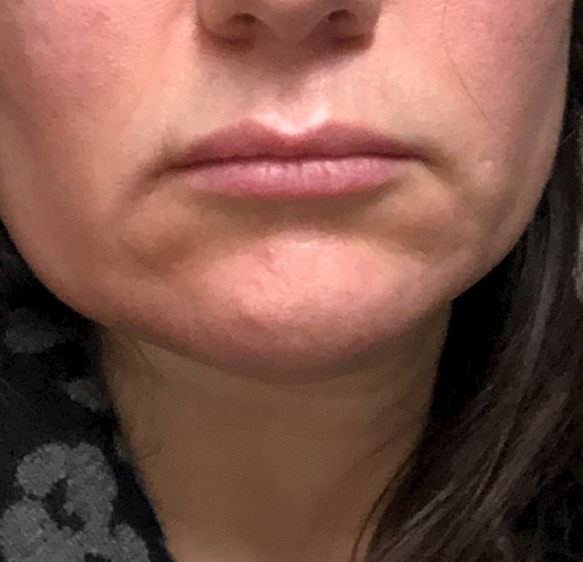 Swelling Underneath Bottom Lip