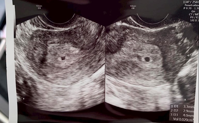 Ultrasound 4 weeks 3 days