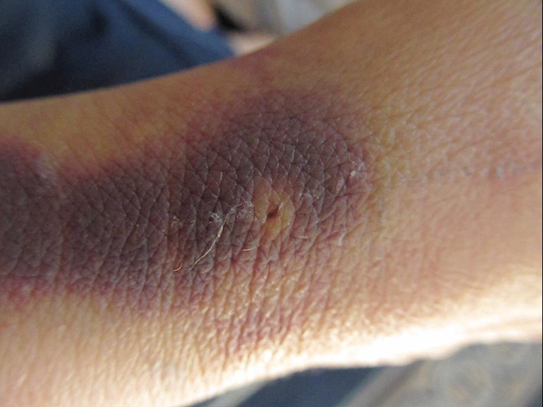 PICC line fear [picture of bruise]: hi, sorry to... - My Ovacome