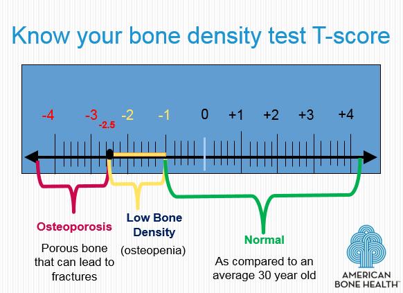 Printable Bone Density Chart