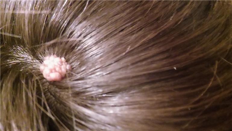 Pilar cyst Causes treatment and removal