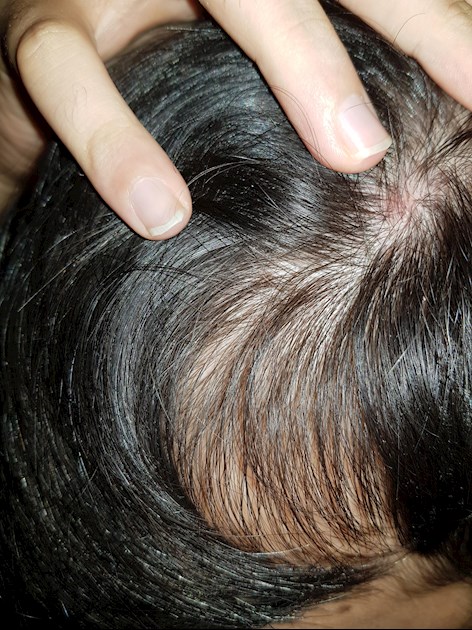 Why does my scalp hurt after I straighten my hair knowing that I don't burn  it? - Quora