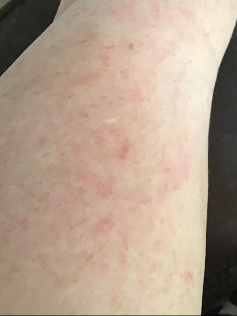 Discoid Lupus Rash On Legs
