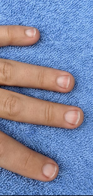 Lindsay's Nails/Half-and-half nails?: My nails... - Thyroid UK