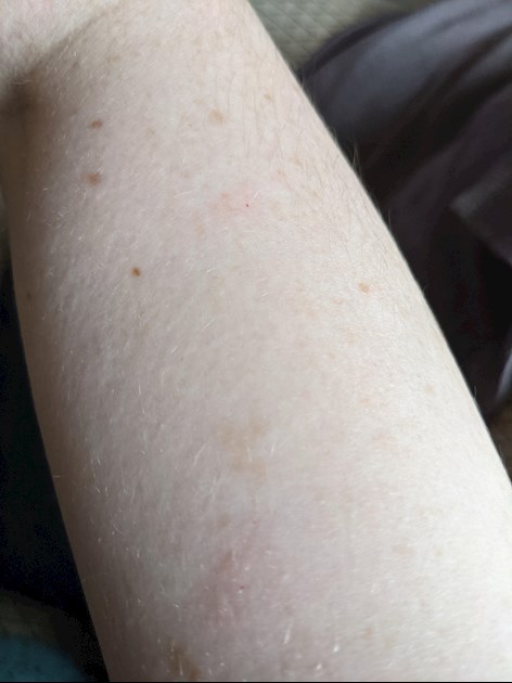 What Are The Tiny Red Dots On My Arms