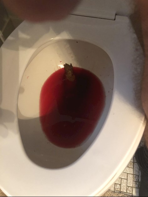 How Much Blood In Stool Is Too Much