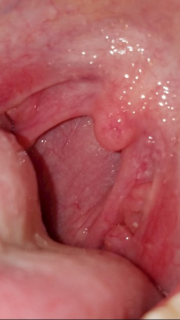 fungus in throat