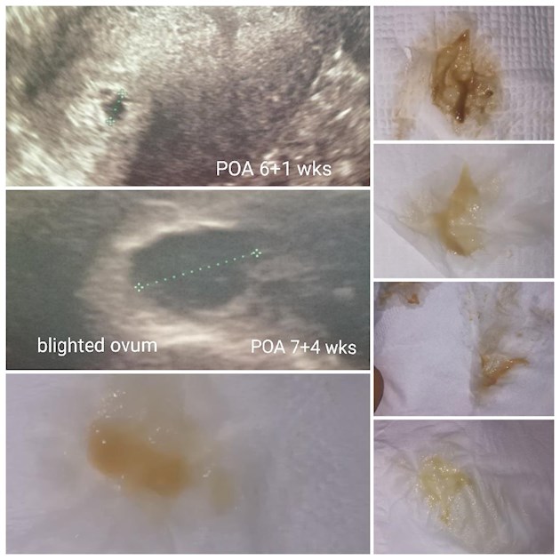 Brown Spotting 6 Week Pregnant Updated I m 6 Week NCT