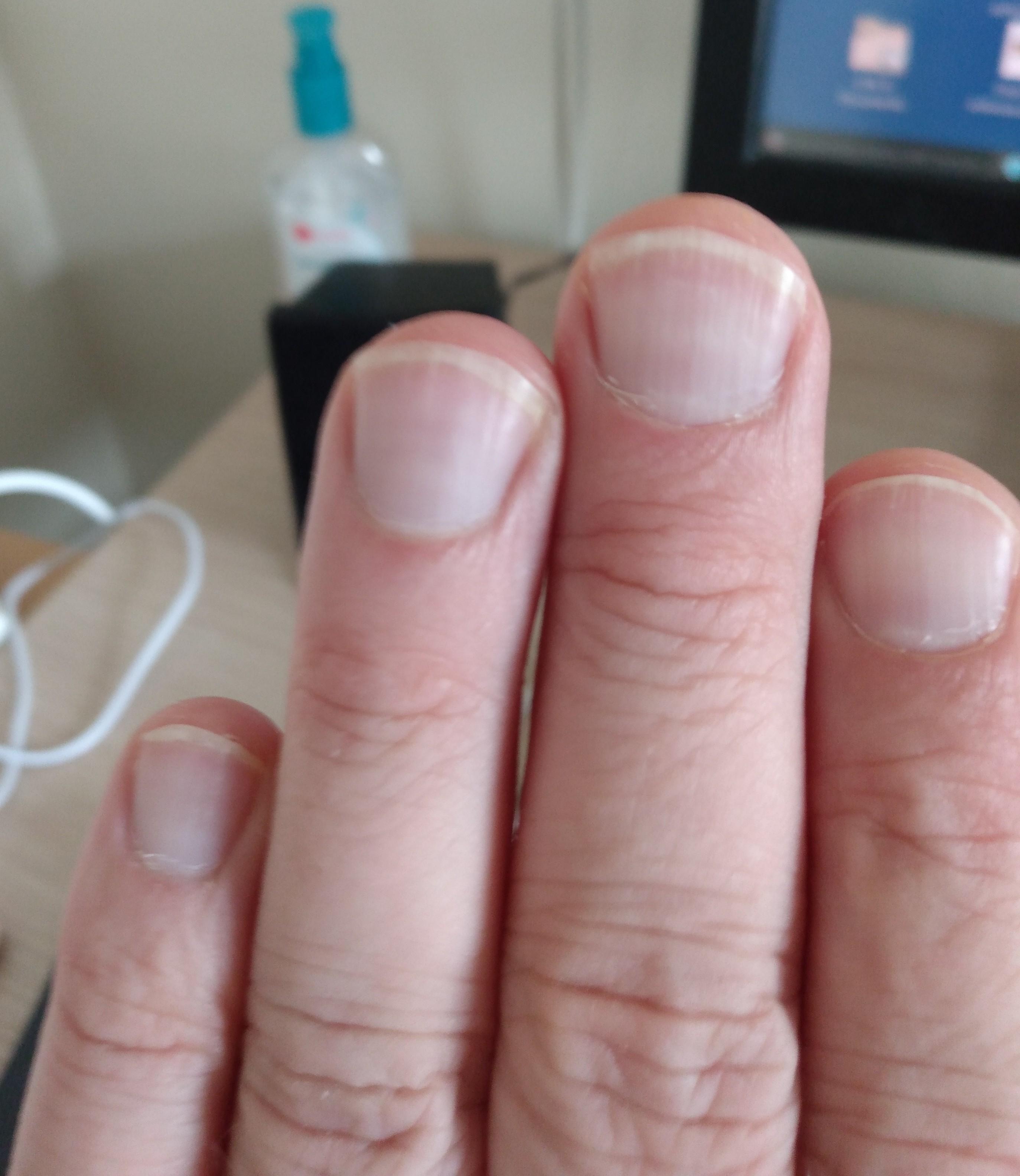 Advanced Specialty Care - Nail psoriasis is an autoimmune disease that  causes discoloration, pitting and changes in the structure of the nails. If  you have changes in the texture of your nails,