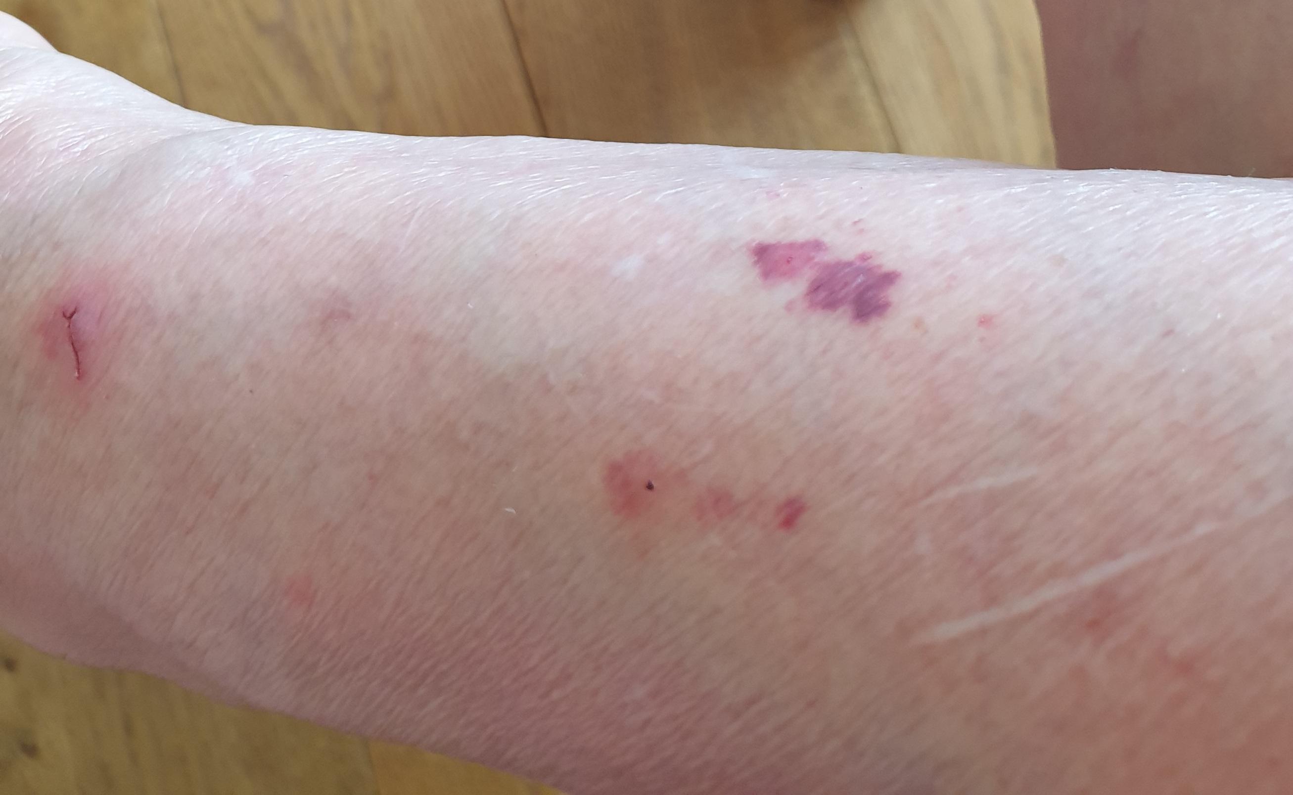 Purple Pressure Rash Rash With Purple Blisters