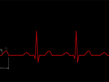Heart rate variability diagram from Wiki