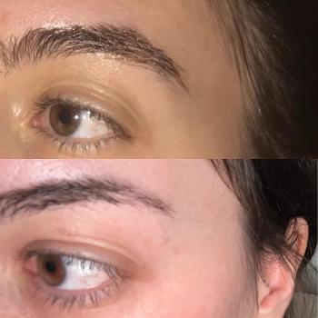 Eyebrow hair loss comparison