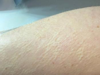 Patchy goosebumps