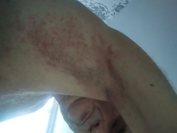 Rash under armpit ,. I wonder if this could be fungal)