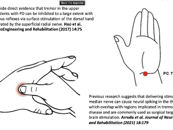 Electrode location to stimulate the radial and median nerves for tremor suppression.