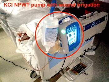 Negative Pressure Wound Therapy pump, with wound irrigation