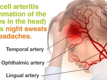 GCA head arteries 